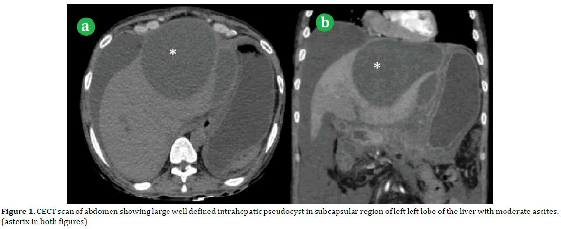 pancreas-abdomen-intrahepatic-pseudocyst