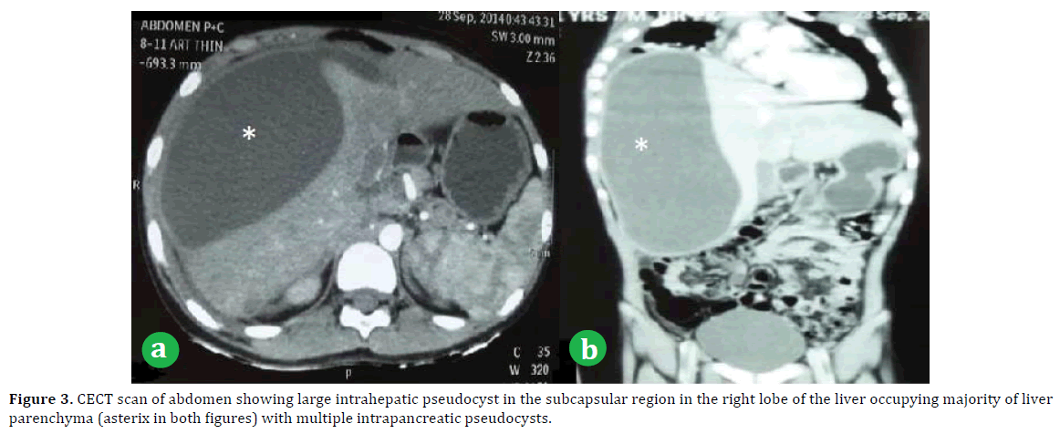 pancreas-abdomen-intrahepatic-pseudocyst