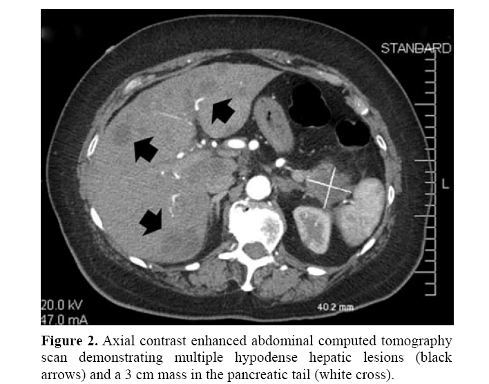 pancreas-abdominal-computed-tomography