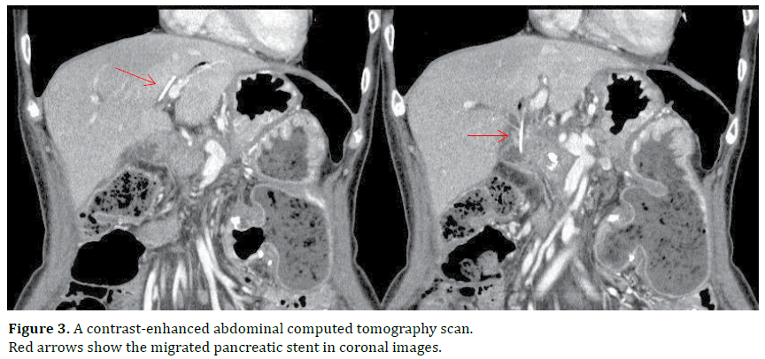 pancreas-abdominal-computed-tomography