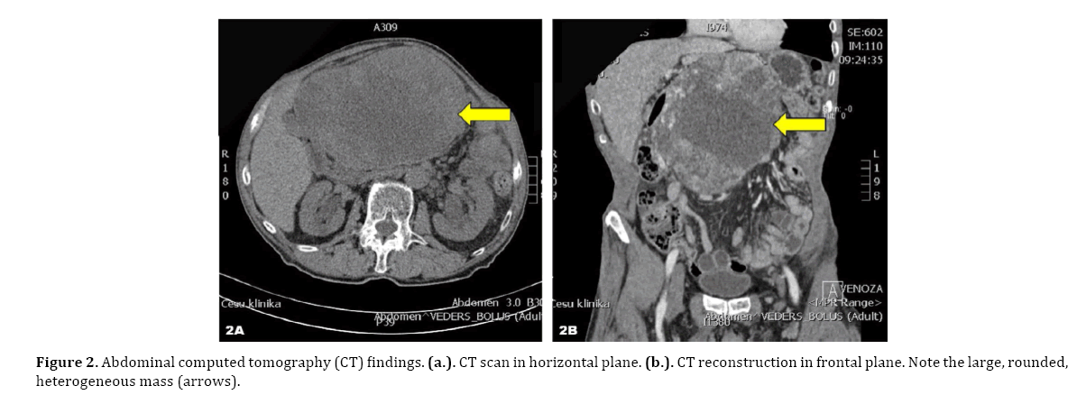pancreas-abdominal-computed-tomography