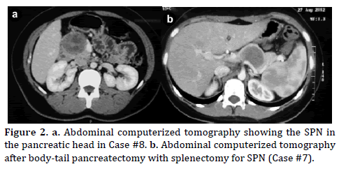 pancreas-abdominal-computerized-tomography