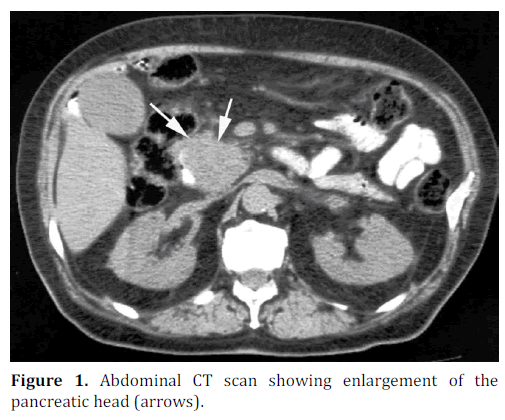 pancreas-abdominal-ct-scan-enlargement