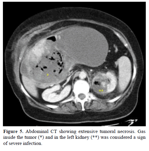 pancreas-abdominal-extensive-tumoral-necrosis