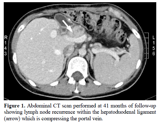 pancreas-abdominal-hepatoduodenal-ligament