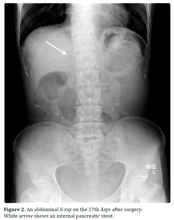 pancreas-abdominal-pancreatic-stent