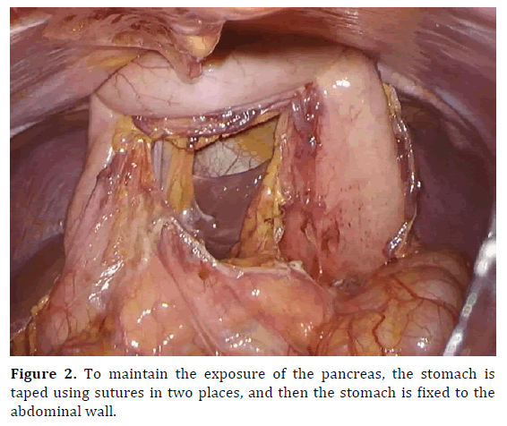 pancreas-abdominal-wall