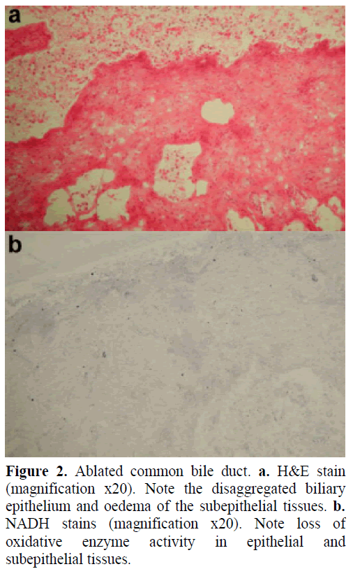 pancreas-ablated-common-bile-duct