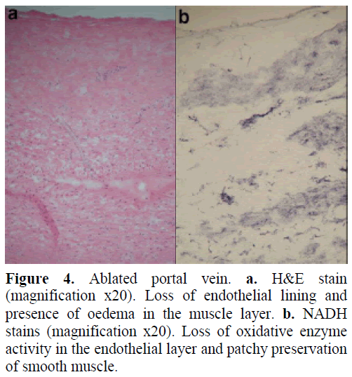 pancreas-ablated-portal-vein-stain