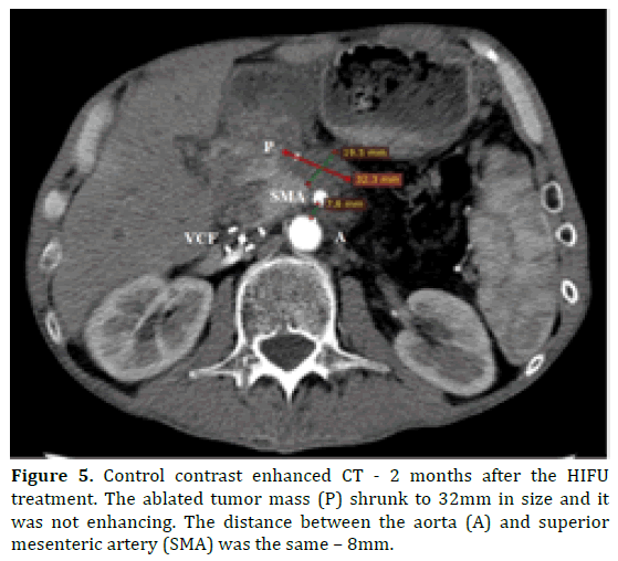 pancreas-ablated-tumor-mass