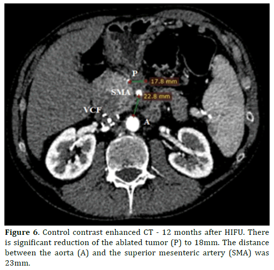 pancreas-ablated-tumor-mesenteric