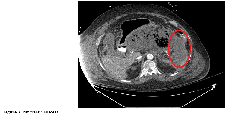 pancreas-abscess