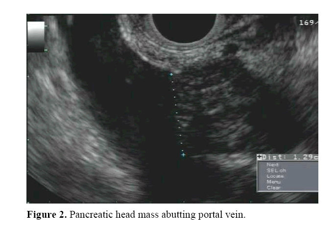 pancreas-abutting-portal-vein