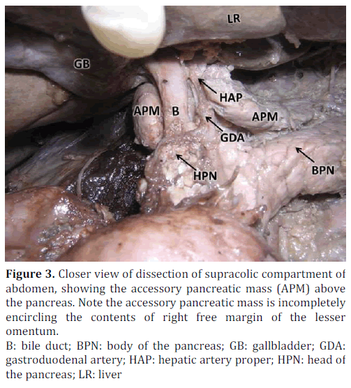 pancreas-accessory-pancreatic-mass