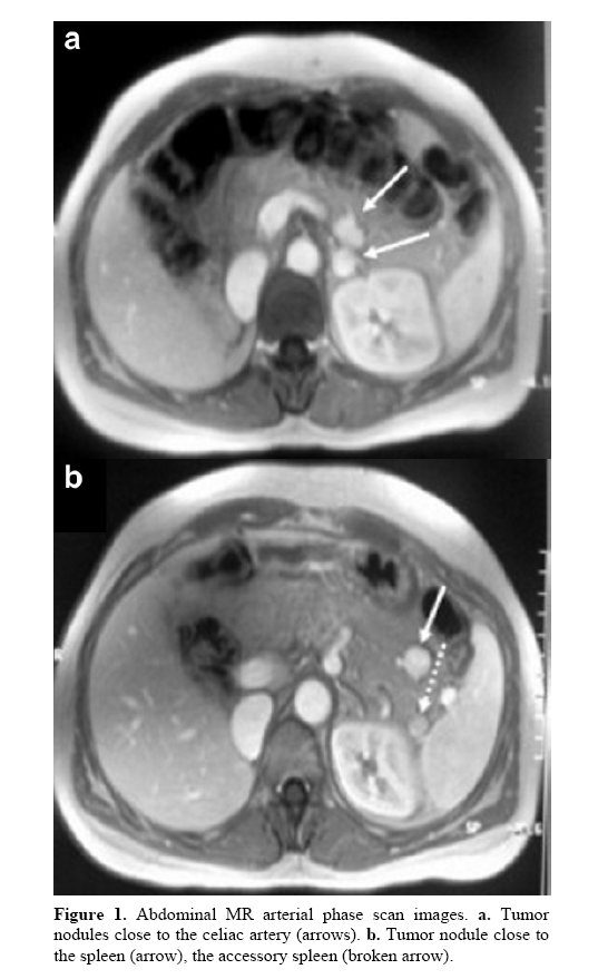 pancreas-accessory-spleen