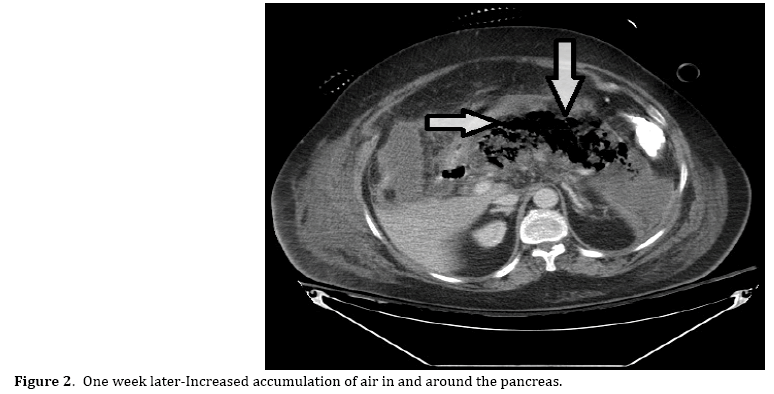 pancreas-accumulation