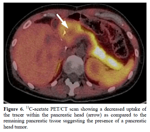 pancreas-acetate-pancreatic-tissue