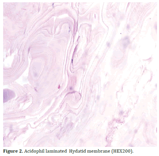 pancreas-acidophil-laminated-hydatid