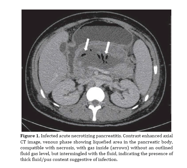 pancreas-acute-necrotizing-pancreatitis