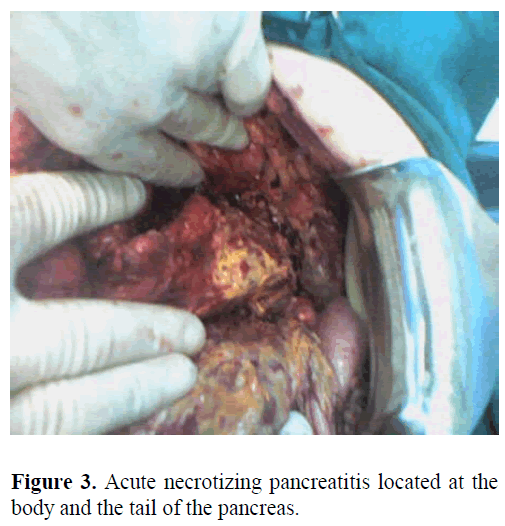 pancreas-acute-necrotizing-pancreatitis
