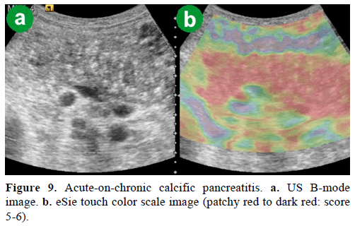 pancreas-acute-on-chronic-calcific-pancreatitis