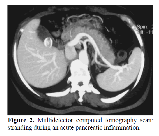 pancreas-acute-pancreatic-inflammation