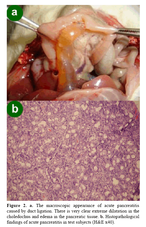 pancreas-acute-pancreatitis