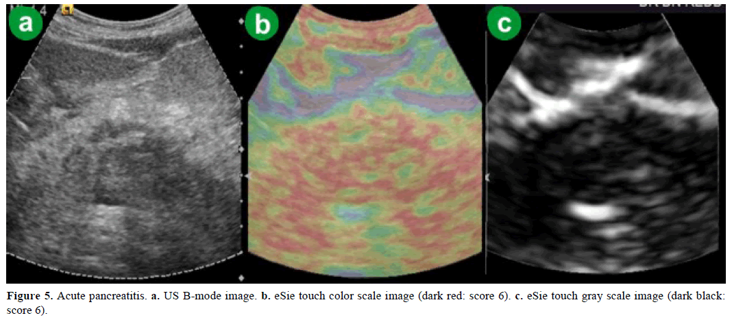 pancreas-acute-pancreatitis-color-scale-image