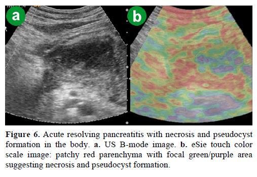 pancreas-acute-resolving-pancreatitis-necrosis