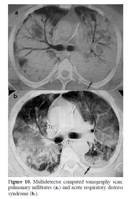 pancreas-acute-respiratory-distress