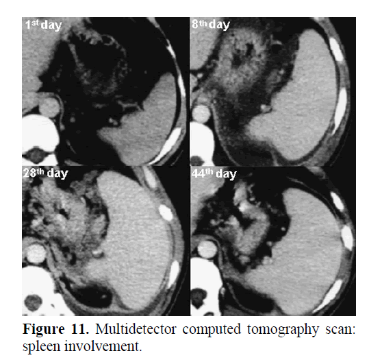 pancreas-acute-spleen-involvement