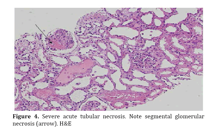 pancreas-acute-tubular-necrosis