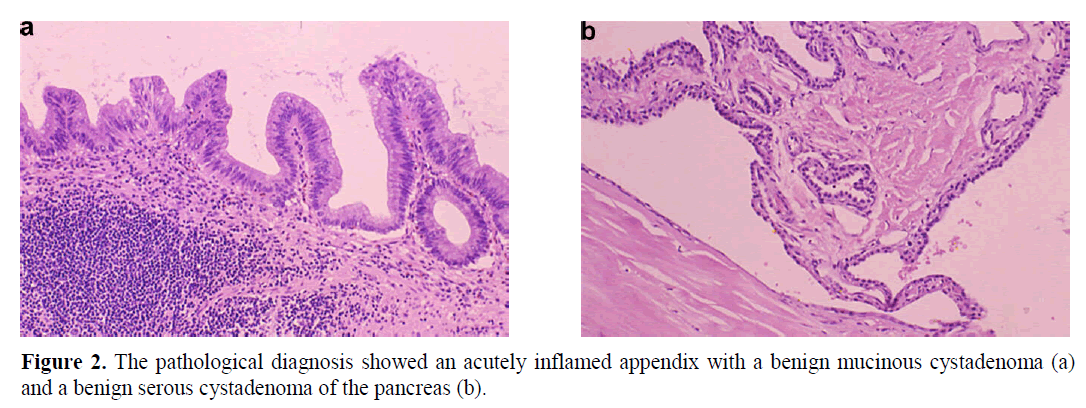 pancreas-acutely-inflamed-appendix