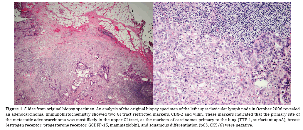 pancreas-adenocarcinoma