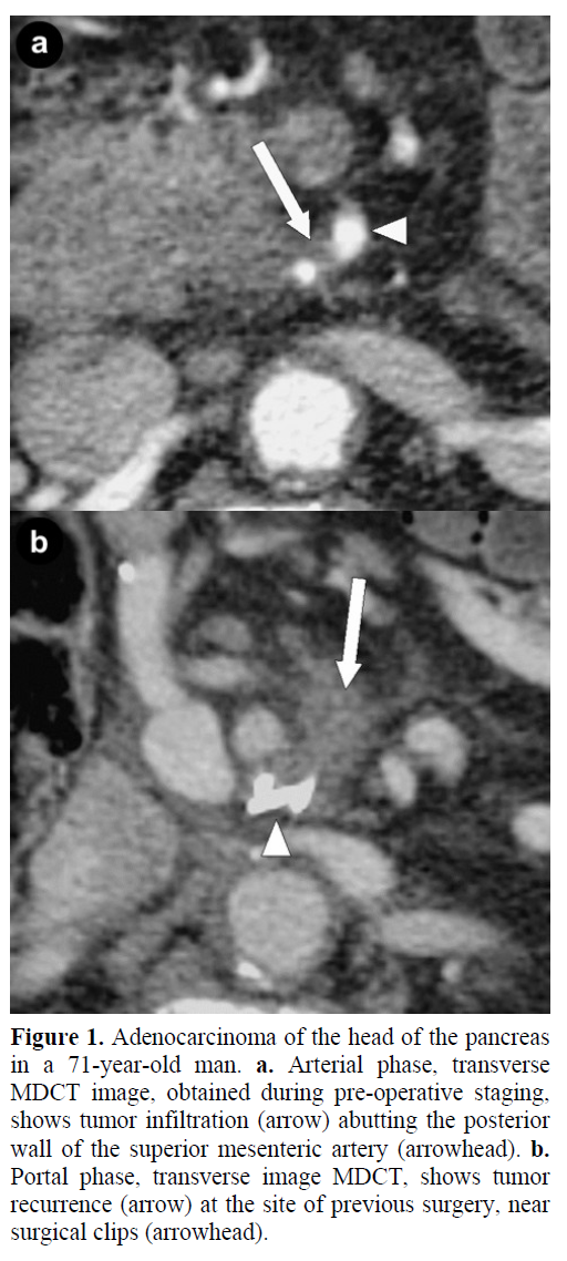 pancreas-adenocarcinoma-head-pancreas