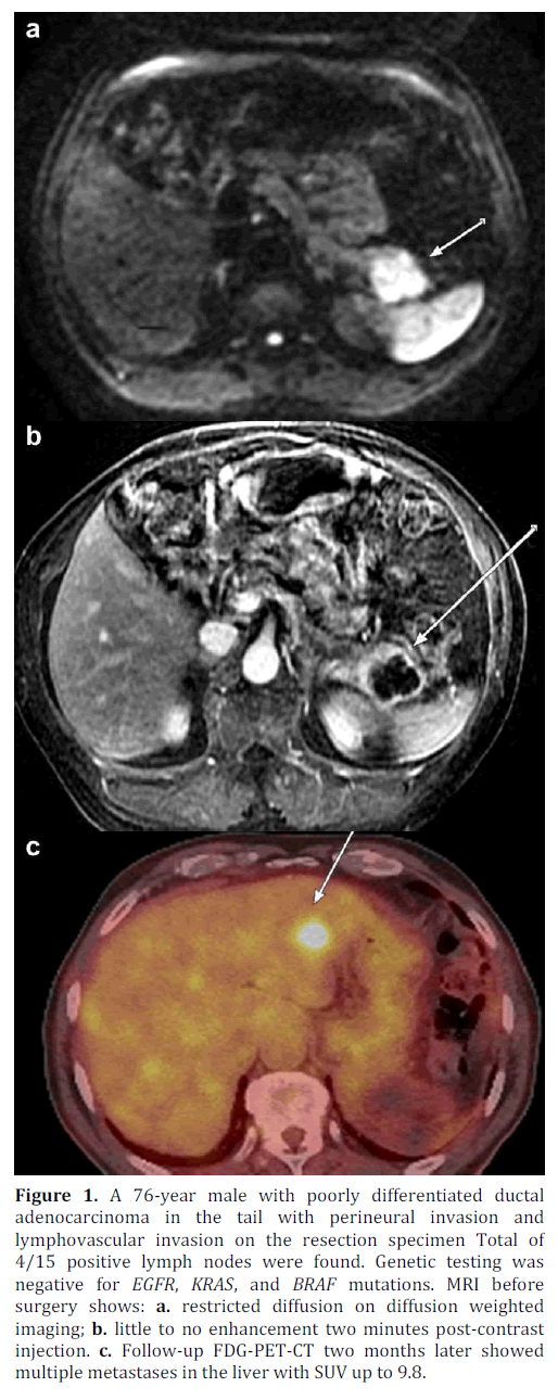 pancreas-adenocarcinoma-perineural-invasion