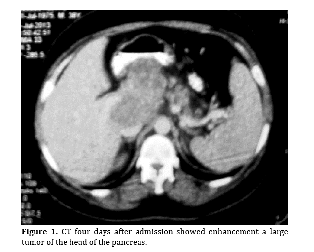 pancreas-admission-showed-enhancement