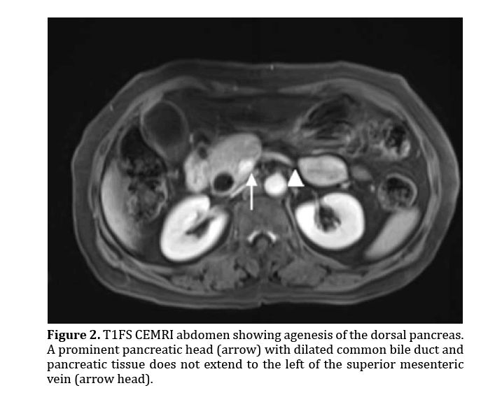 pancreas-agenesis-dorsal-pancreas