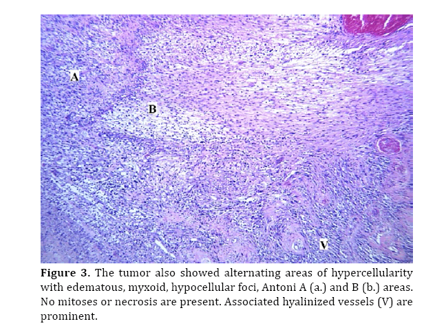 pancreas-alternating-areas-hypercellularity