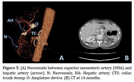 pancreas-amplatzer-device