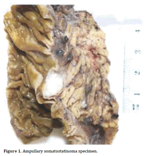 pancreas-ampullary-somatostatinoma-specimen