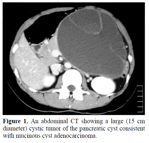 pancreas-an-abdominal-ct-cystic-tumor