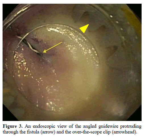 pancreas-an-endoscopic-angled-guidewire