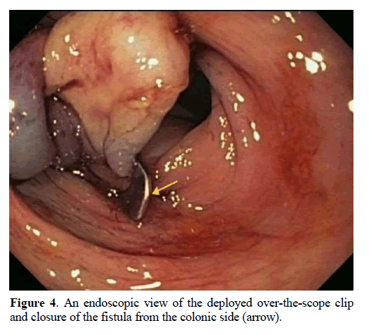 pancreas-an-endoscopic-over-the-scope