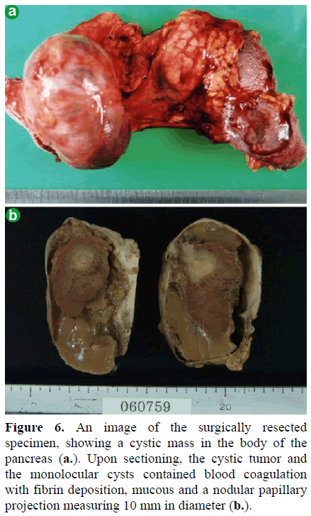 pancreas-an-image-surgically-specimen