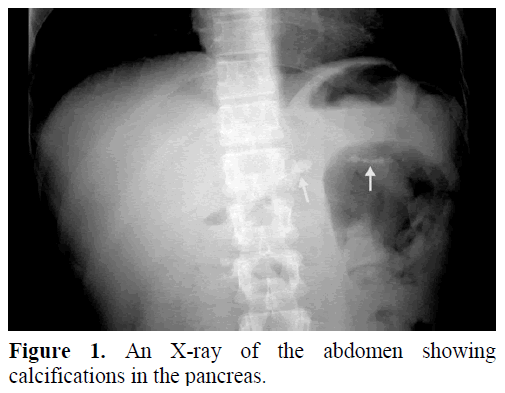 pancreas-an-x-ray-abdomen-calcifications-pancreas