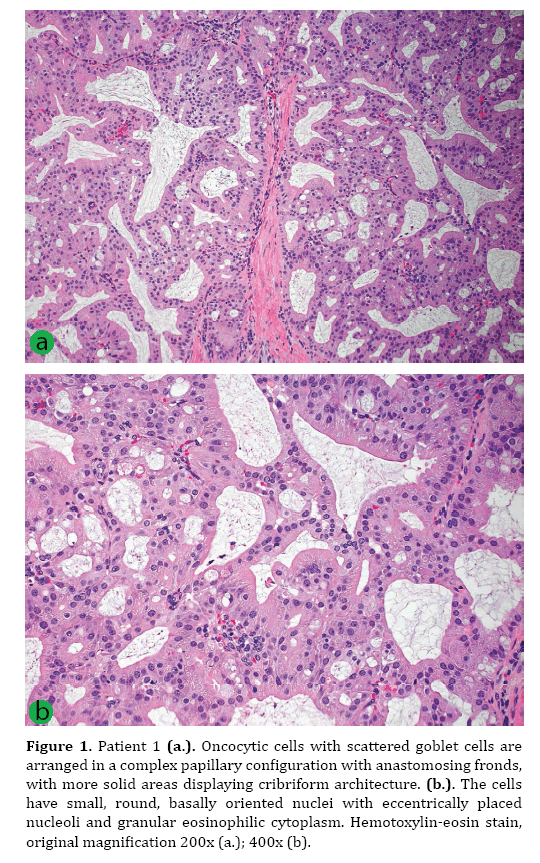 pancreas-anastomosing-fronds