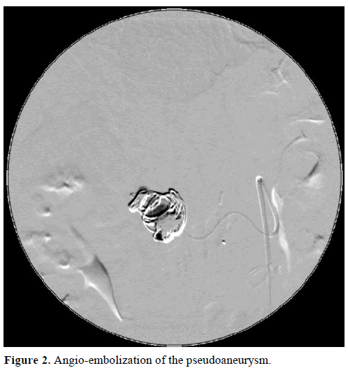 pancreas-angio-embolization