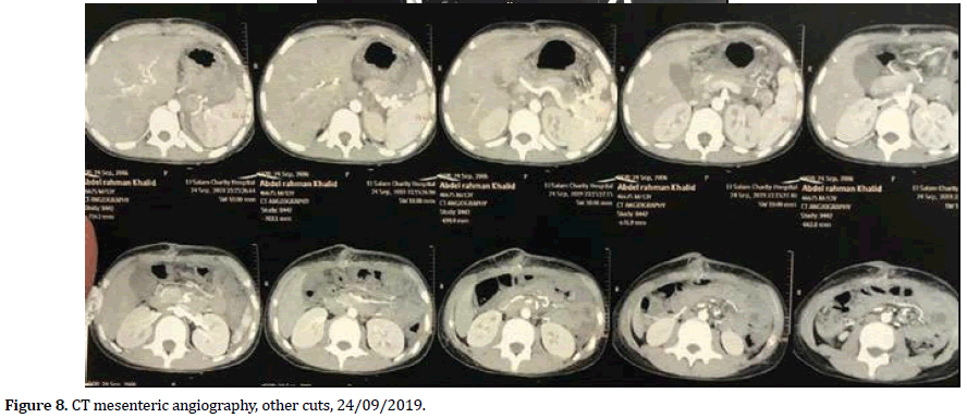 pancreas-angiography