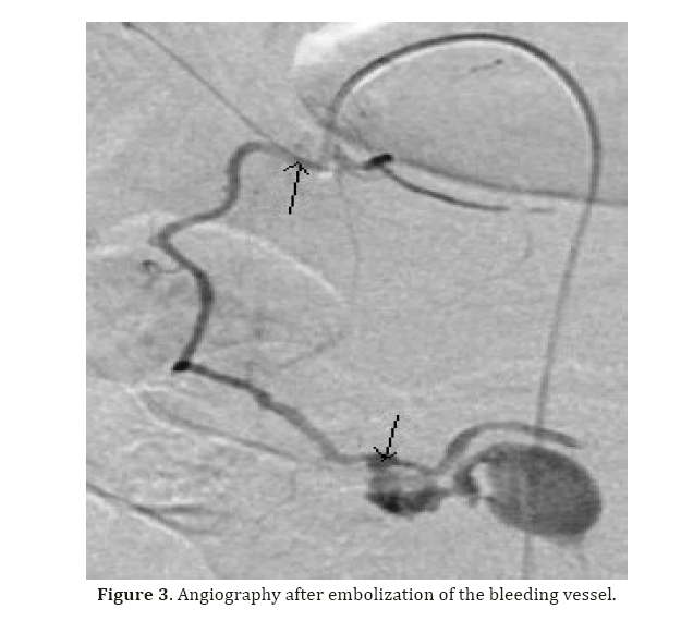 pancreas-angiography-after-embolization